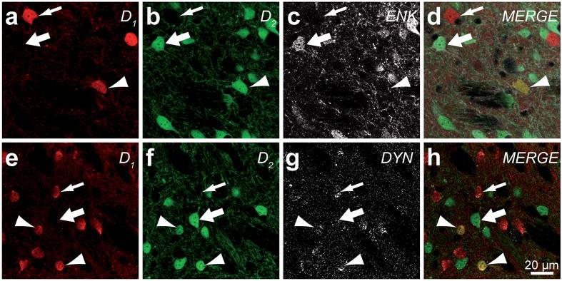 Striatal Neurons Expressing D1 and D2 Receptors are Morphologically Distinct and Differently Affected by Dopamine Denervation in Mice