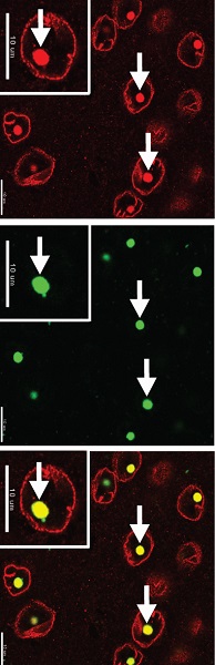 In Huntington’s Disease, Traffic Jams in The Cell’s Control Center Kill Brain Cells