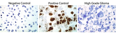 Study Finds No Evidence Of Common Herpes Type Virus In Aggressive Brain Cancer Tissue