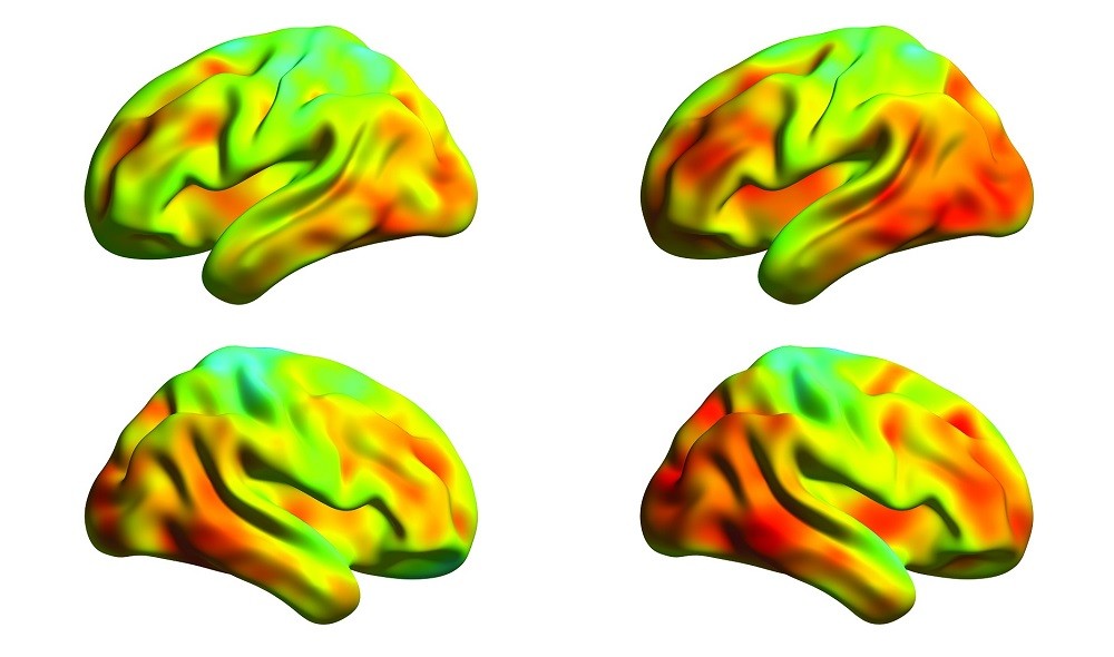 Spread of tau protein measured in the brains of Alzheimer’s patients