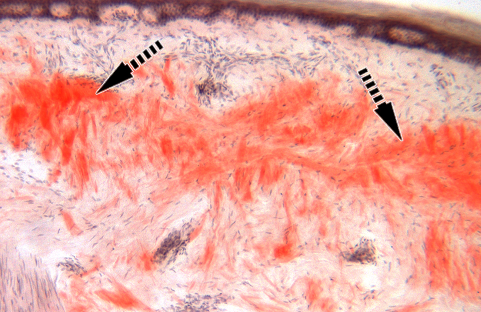 Faster Diagnosis of Inherited and Lethal Nerve Disease Could Advance Search for New Treatments