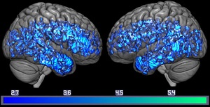 Brain Scan Study Adds to Evidence That Lower Brain Serotonin Levels are Linked to Dementia