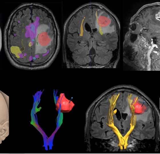 How Liquid Biopsy Could Improve Brain Tumor Treatment and Diagnoses