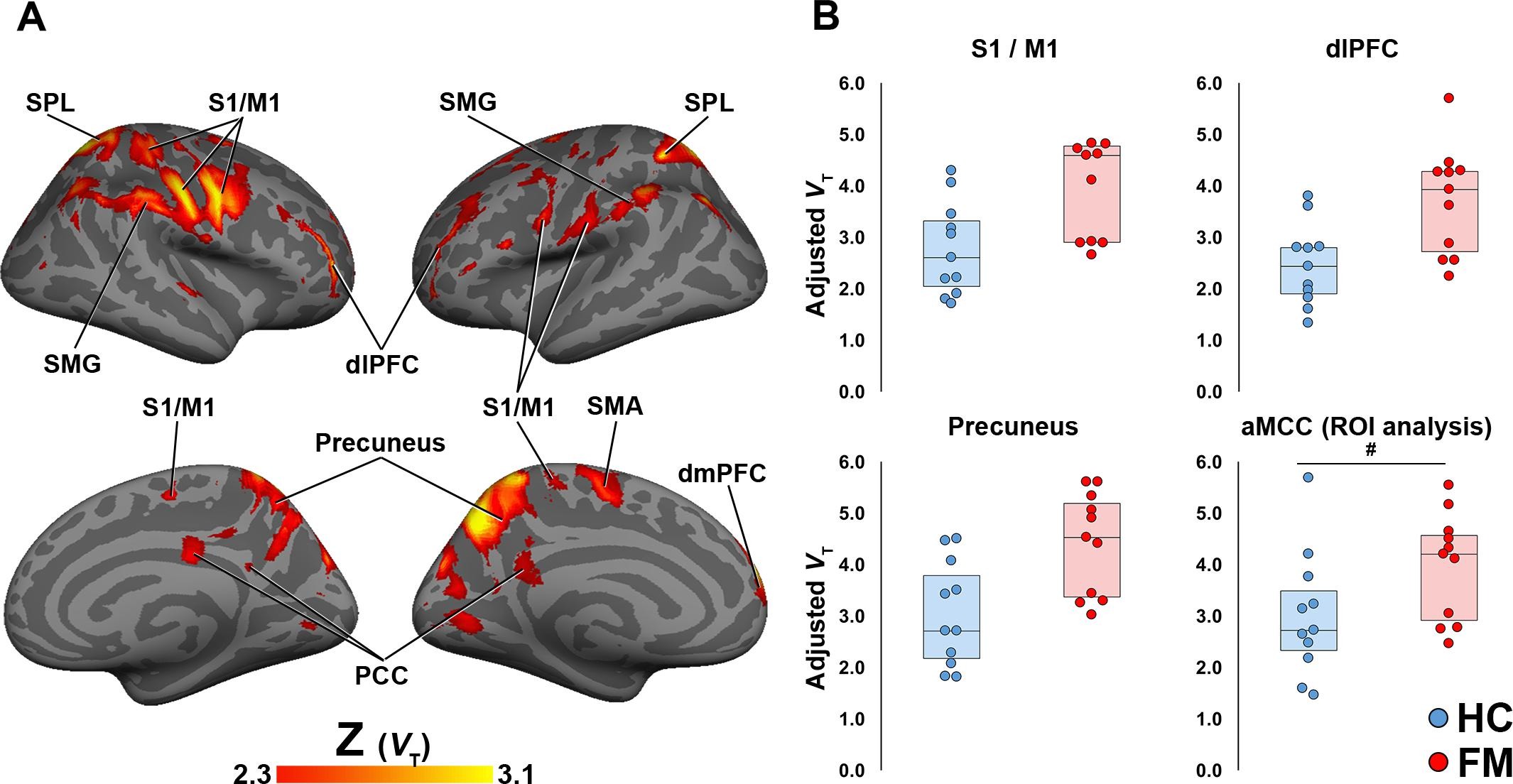 People with fibromyalgia have inflammation of the brain