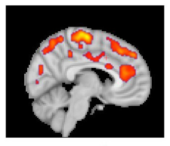 Research teams find widespread inflammation in the brains of fibromyalgia patients